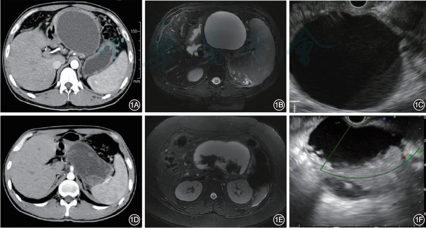 一文“get”胰腺假性囊腫的診療丨臨床必備