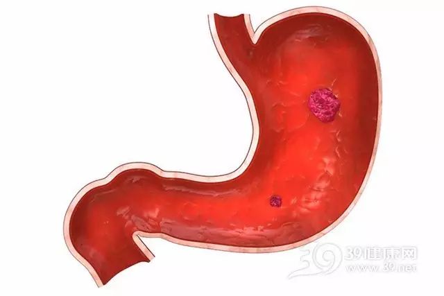 這種胃痛，是胃癌來臨的預報！