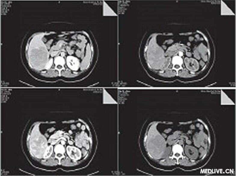 【PHILIPS每日一例】【誤診分析】肝臟血管平滑肌脂肪瘤誤診為肝癌一例