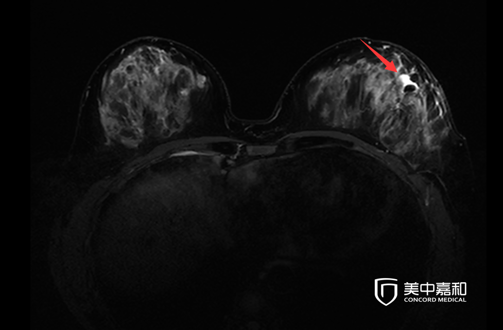保乳術后，保了“美麗”但留了“隱患” ？為您解惑！