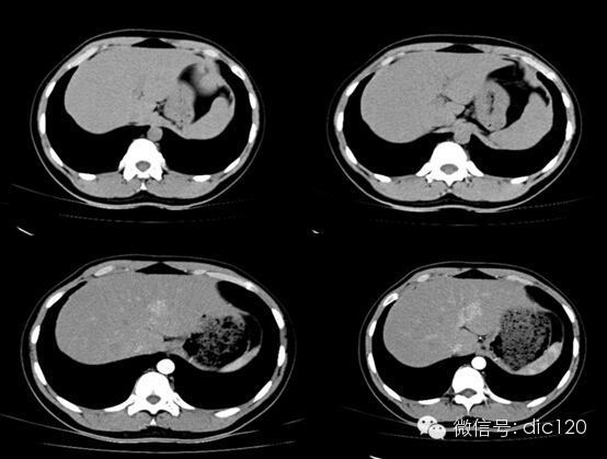 肝局灶性結(jié)節(jié)增生（FNH）