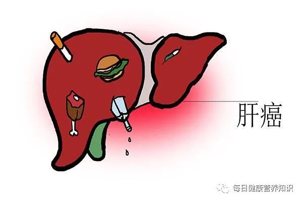 肝癌來臨，大小便先知？