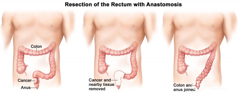 直腸癌怎么治療？如何在“保命”的基礎(chǔ)上實(shí)現(xiàn)“保肛”？