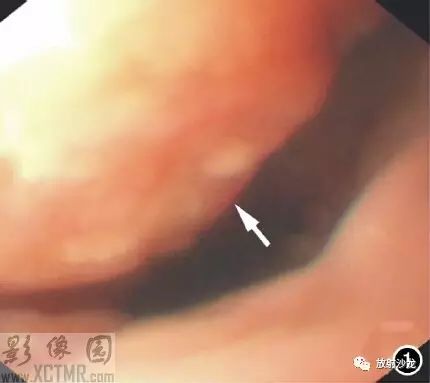 【每日一例 | 375期】食管占位性病變影像病例