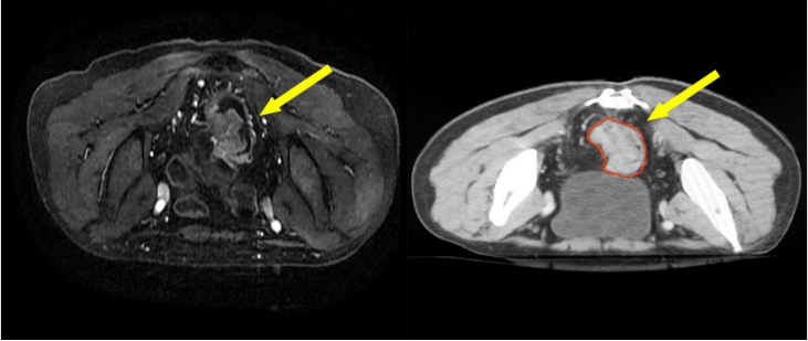 直腸癌的三維放療及調(diào)強(qiáng)放療靶區(qū)勾畫(huà)